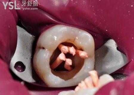 根管治療為什么需要顯微鏡？