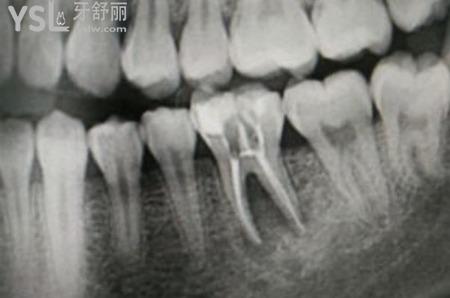 一次根管治療要幾小時(shí)？