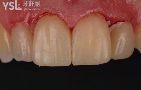 什么是全瓷貼面修復？