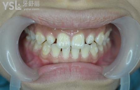 什么癥狀比較適合做瓷貼面？