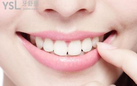 瓷貼面后該怎么自我維護(hù)和保養(yǎng)？