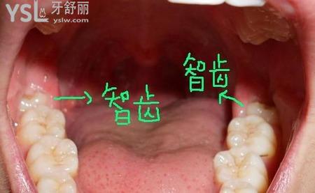 智齒不歪需要拔掉嗎？