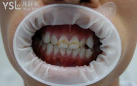 氟斑牙是怎么形成的？