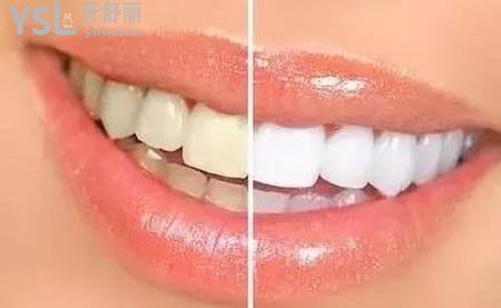 為什么每天刷牙牙齒還是很黃？