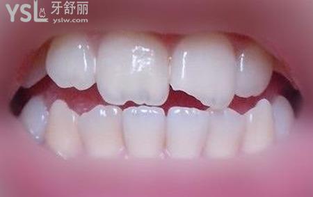 門牙磕掉一小塊怎么處理？