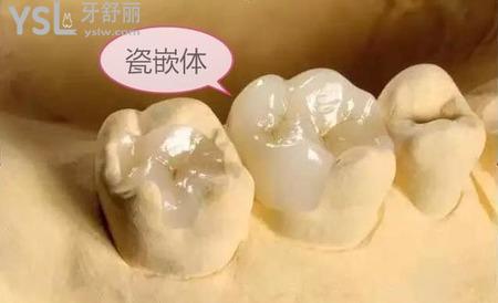 嵌體補牙后能用幾年？