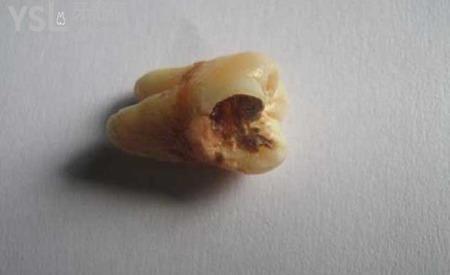 智齒爛了大洞疼得要死怎么辦？