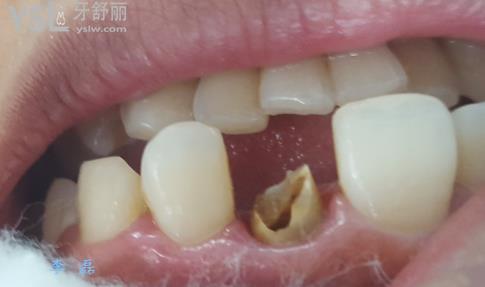 爛牙根十年了很臭怎么辦？