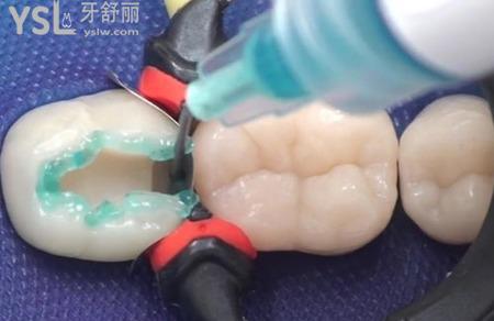 補牙后疼痛怎么辦？