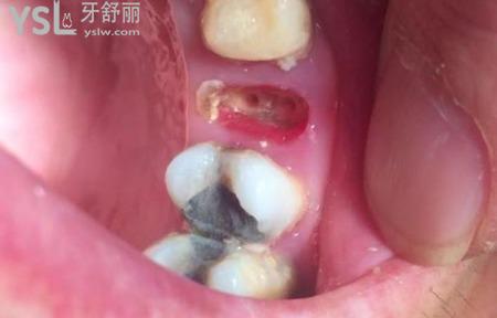 拔智齒后牙洞塞食物怎么辦？
