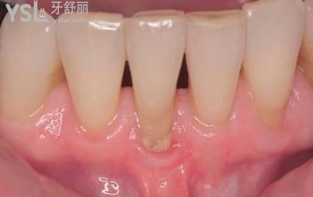牙根長在外面了怎么辦？
