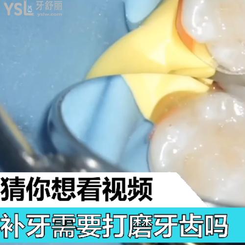 補牙需要打磨牙齒嗎？