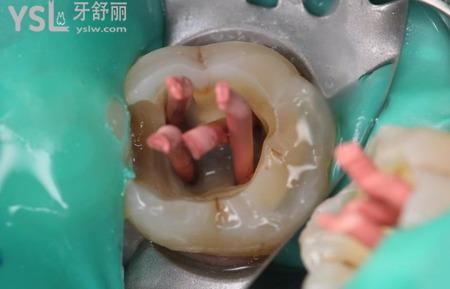 為什么牙髓炎突然不疼了怎么回事？