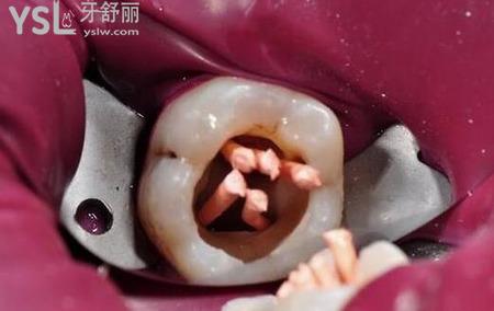 殺完神經(jīng)補(bǔ)牙疼嗎？
