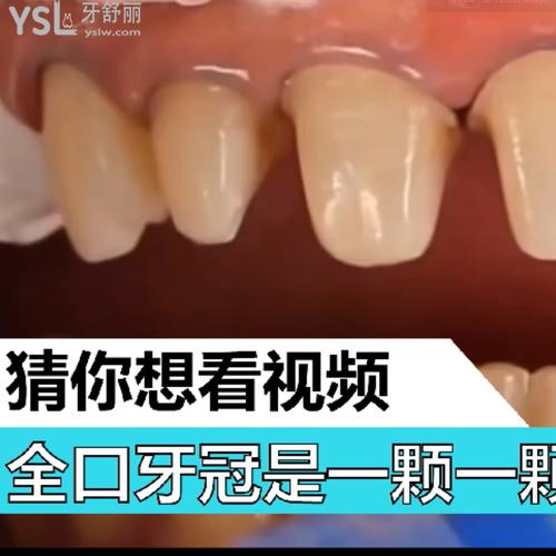 全口牙冠是一顆一顆的做的嗎？