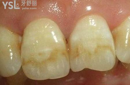 石斑牙怎么治療？