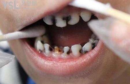 后槽牙里面凹陷處發(fā)黑怎么辦？