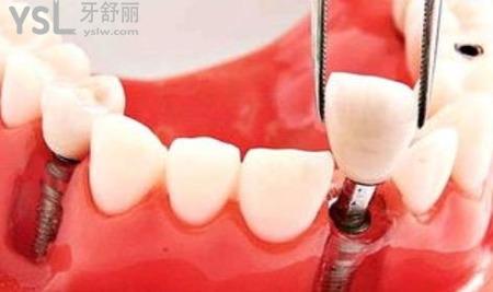 哪種假牙傷害最??？