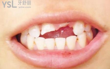 牙斷掉了牙根還需要拔掉嗎？