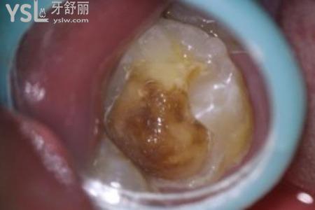 什么是光固化樹脂修復(fù)？