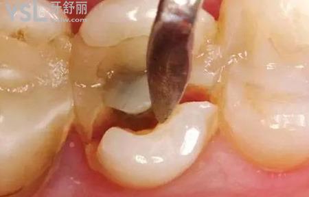 大牙掉了一小塊能長么？