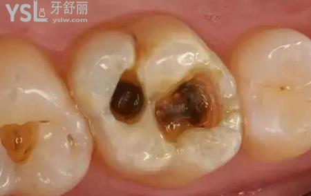 大牙上有黑點(diǎn)是怎么回事？