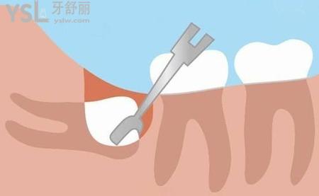 拔磨牙后一般要疼幾天？