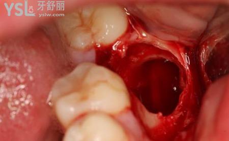 拔過(guò)智齒后有一個(gè)洞怎么辦？