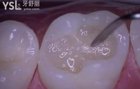 牙齒空了一半可以補(bǔ)嗎？