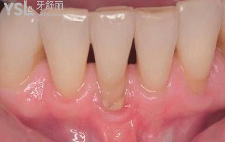 牙周炎發(fā)生后幾天能好嗎？