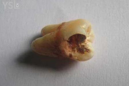 智齒拔牙多久能好？