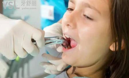 牙痛的時(shí)候可以拔牙嗎？