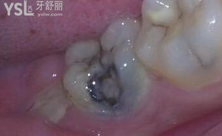 牙齒凹槽上面有黑色怎么去除？