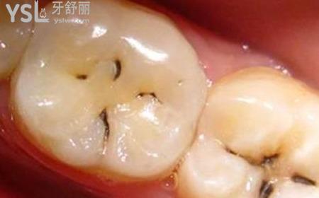 輕度較淺齲齒怎么治療？