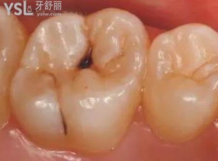 蛀牙會傳染相鄰的牙嗎？