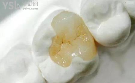 嵌體補牙多少錢？