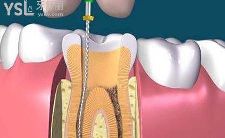牙齒根管治療后需要做牙套嗎？