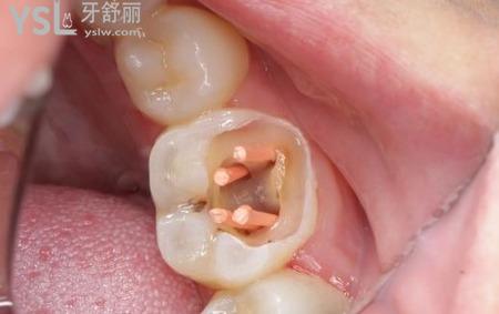 牙科根管治療是什么？