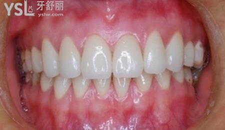 牙槽突裂是怎么發(fā)育的？
