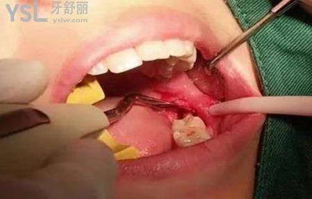 拔智齒后一周吃什么？