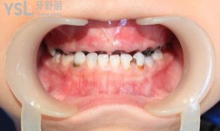 牙根黑了怎么治療？