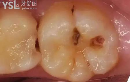 如果牙齒有洞怎么辦？