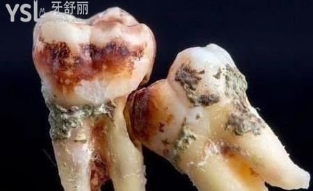 阻生齒拔掉后有個(gè)洞怎么辦？