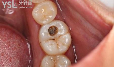 齲齒會痛嗎？
