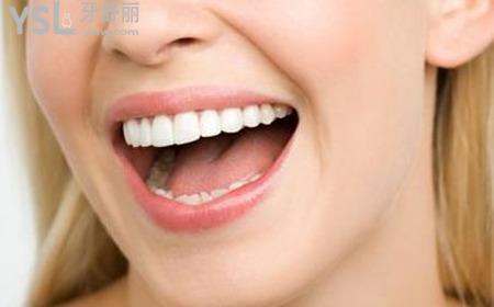 美容冠矯正牙齒多少錢？
