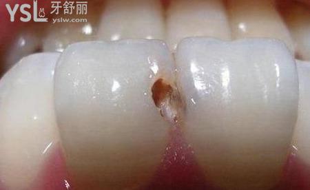 兩個牙齒之間的根部有洞,該怎么處理？