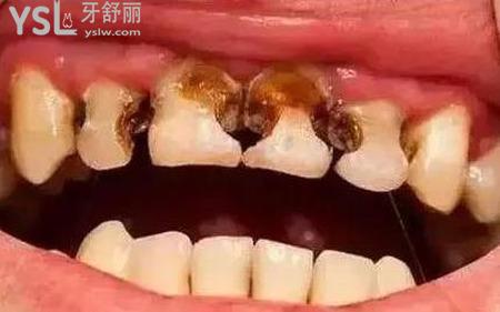 爛牙痛應(yīng)該怎么快速止痛？