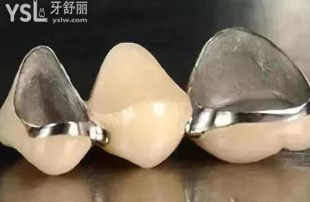 烤瓷牙是怎么安裝的？