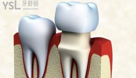 做個牙冠需要多少錢？
