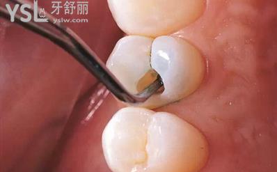 智齒爛了大洞不拔會怎么樣？